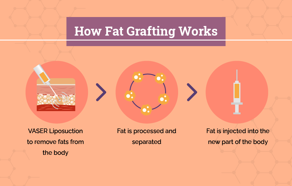 Fat Grafting Procedure