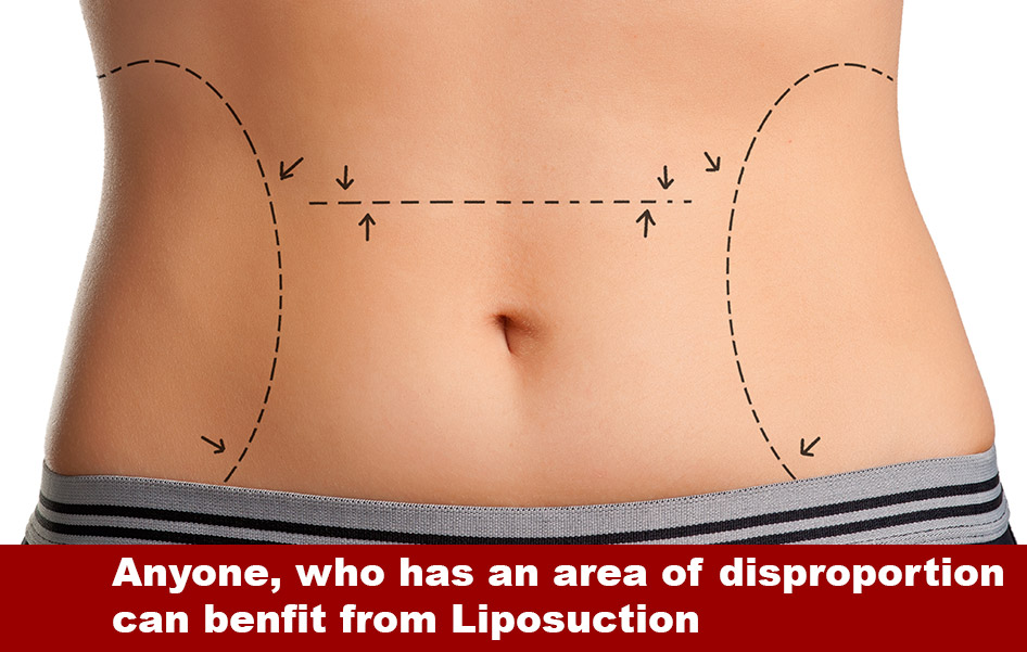 liposuction_procedure