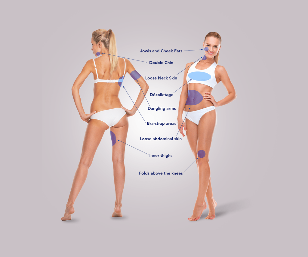Areas that can be treated by Bodytite or Renuvion