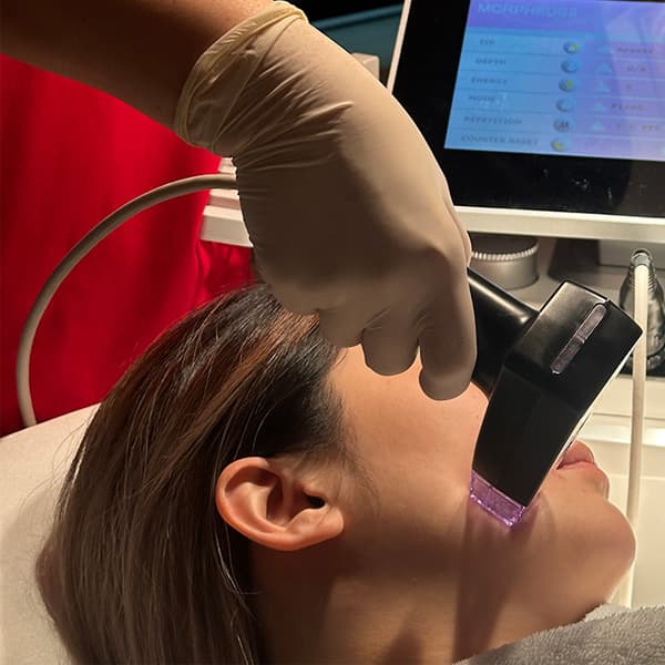 Microneedling RF Procedure